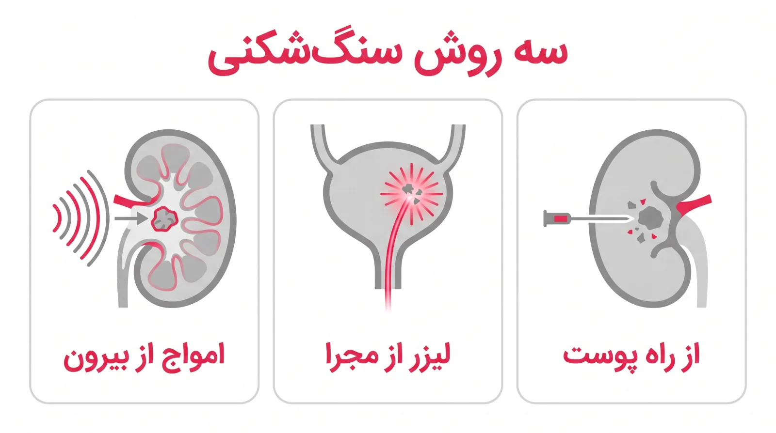 اینفوگرافیک سه روش سنگشکنی کلیه: امواج، یورتروسکوپی و PCNL