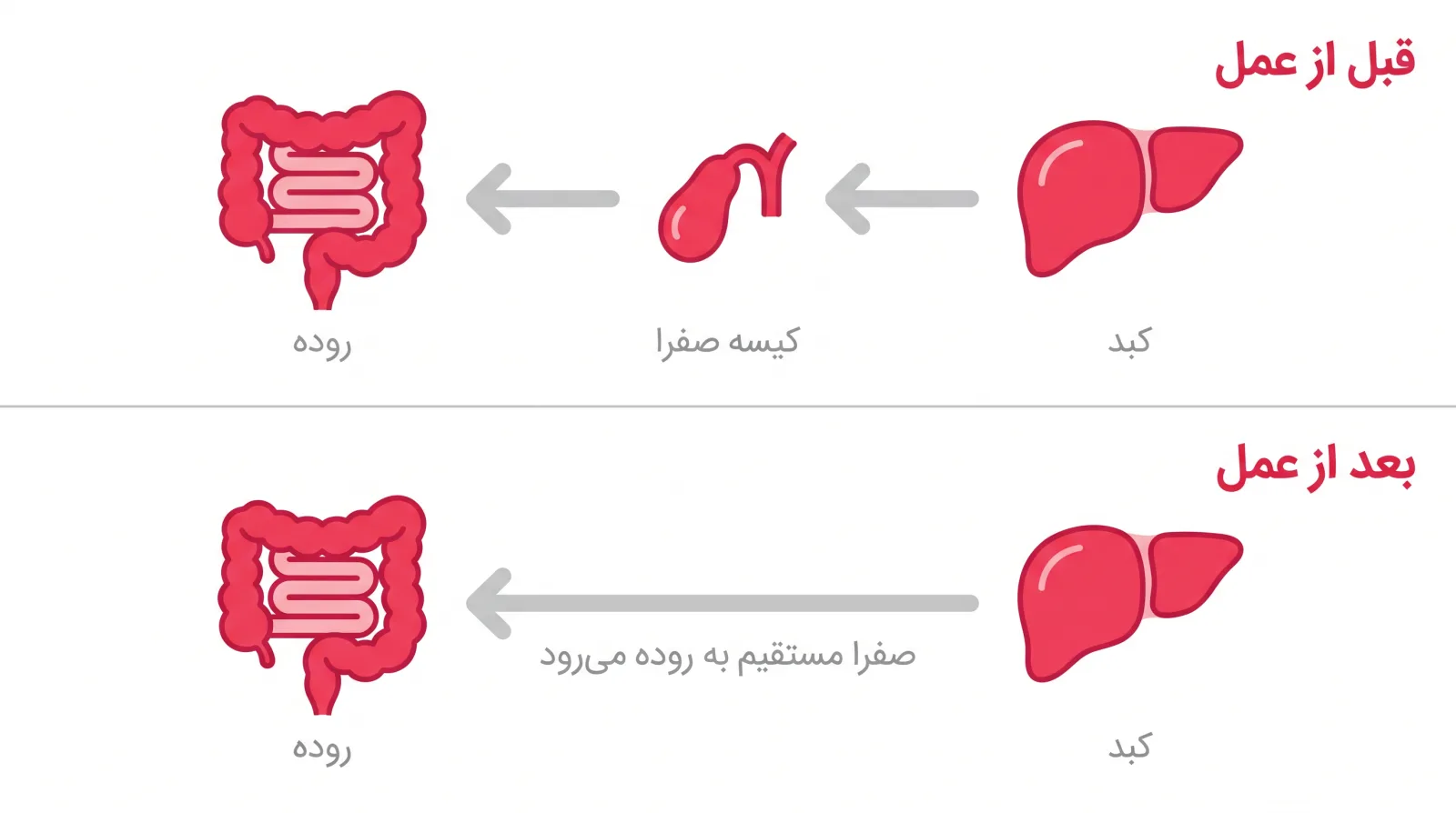 مسیر صفرا قبل و بعد از برداشتن کیسه صفرا: از کبد مستقیم به روده