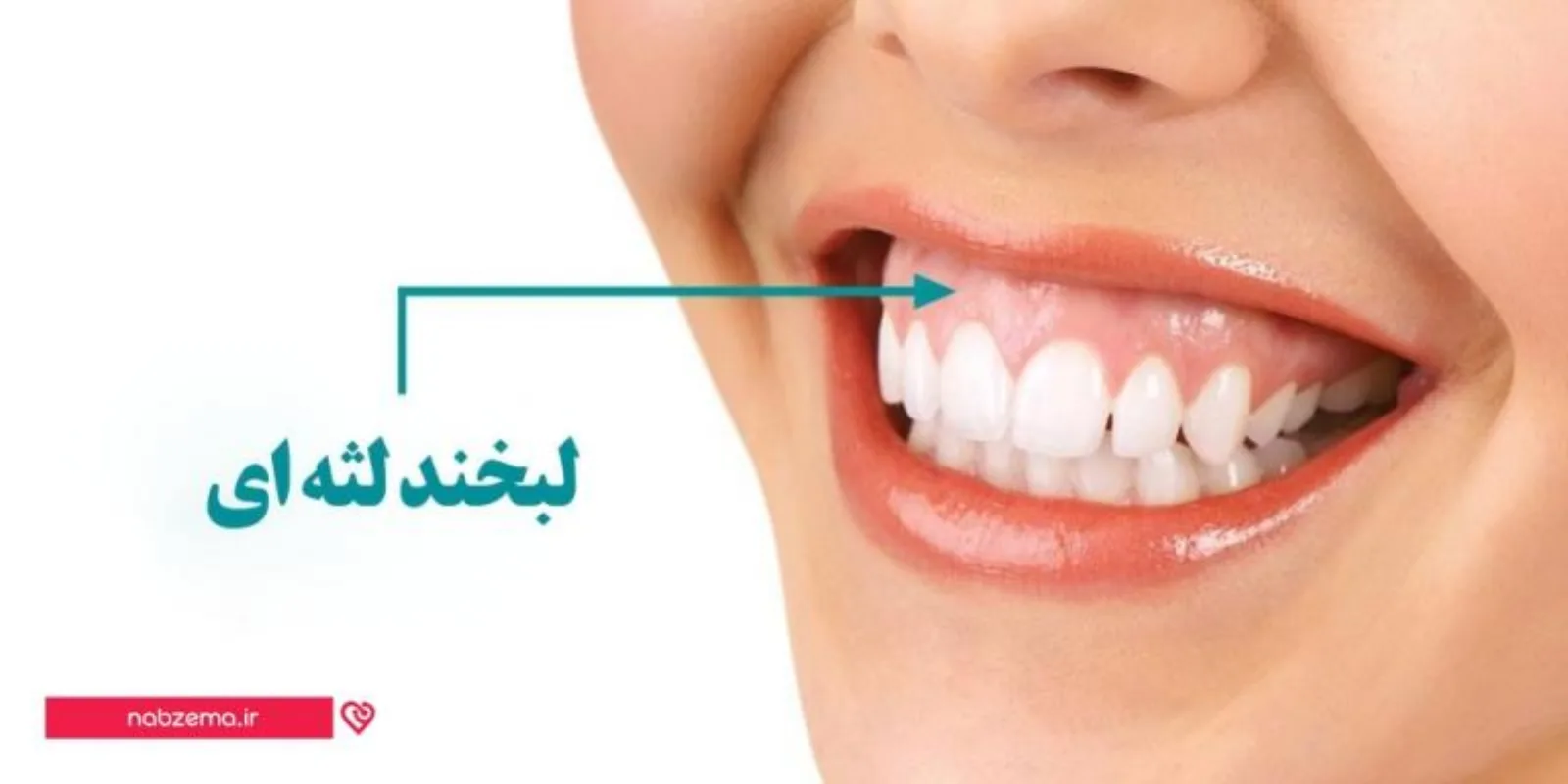 عکس اصلاح لبخند لثه ای