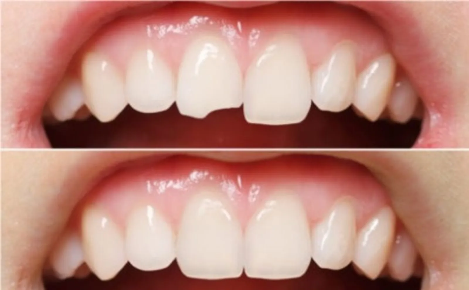 باندینگ دندان