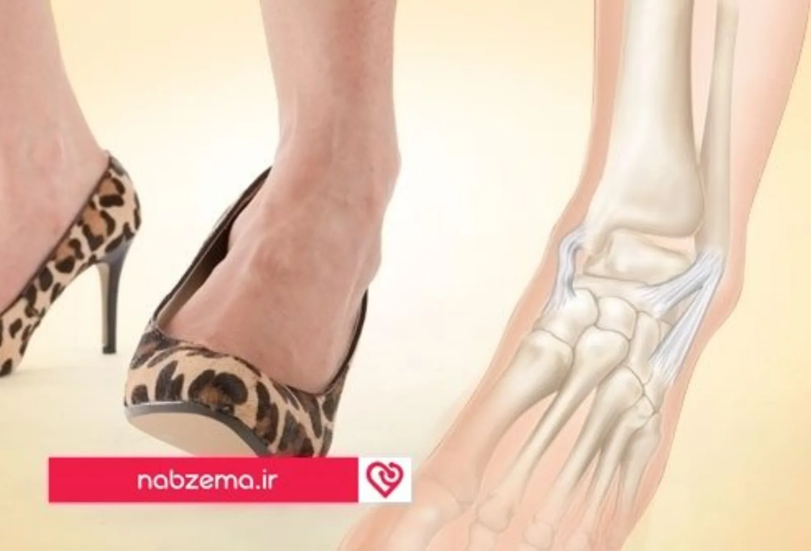 webmd_rf_photo_of_ankle_sprain_risk