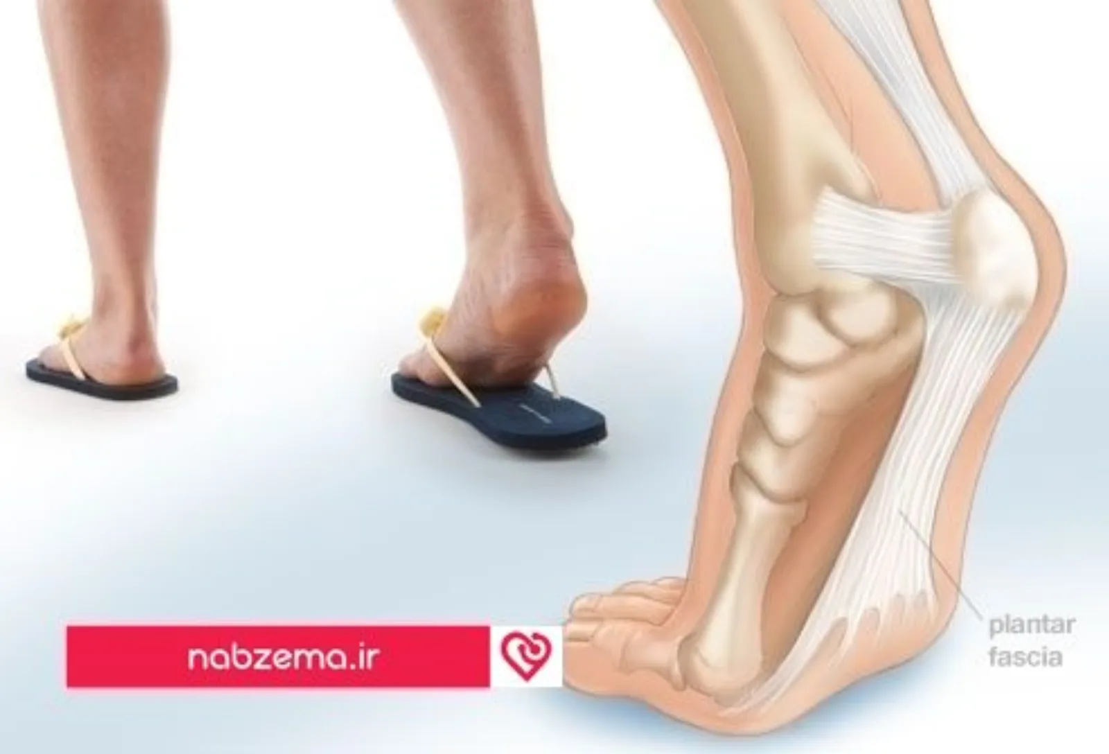 webmd_rf_photo_of_plantar_fasciitis
