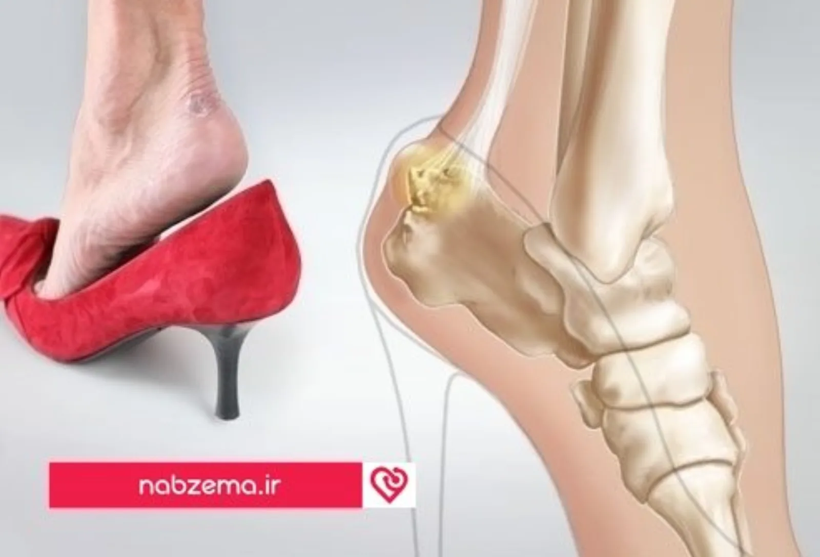webmd_rf_photo_of_pump_bump_composite