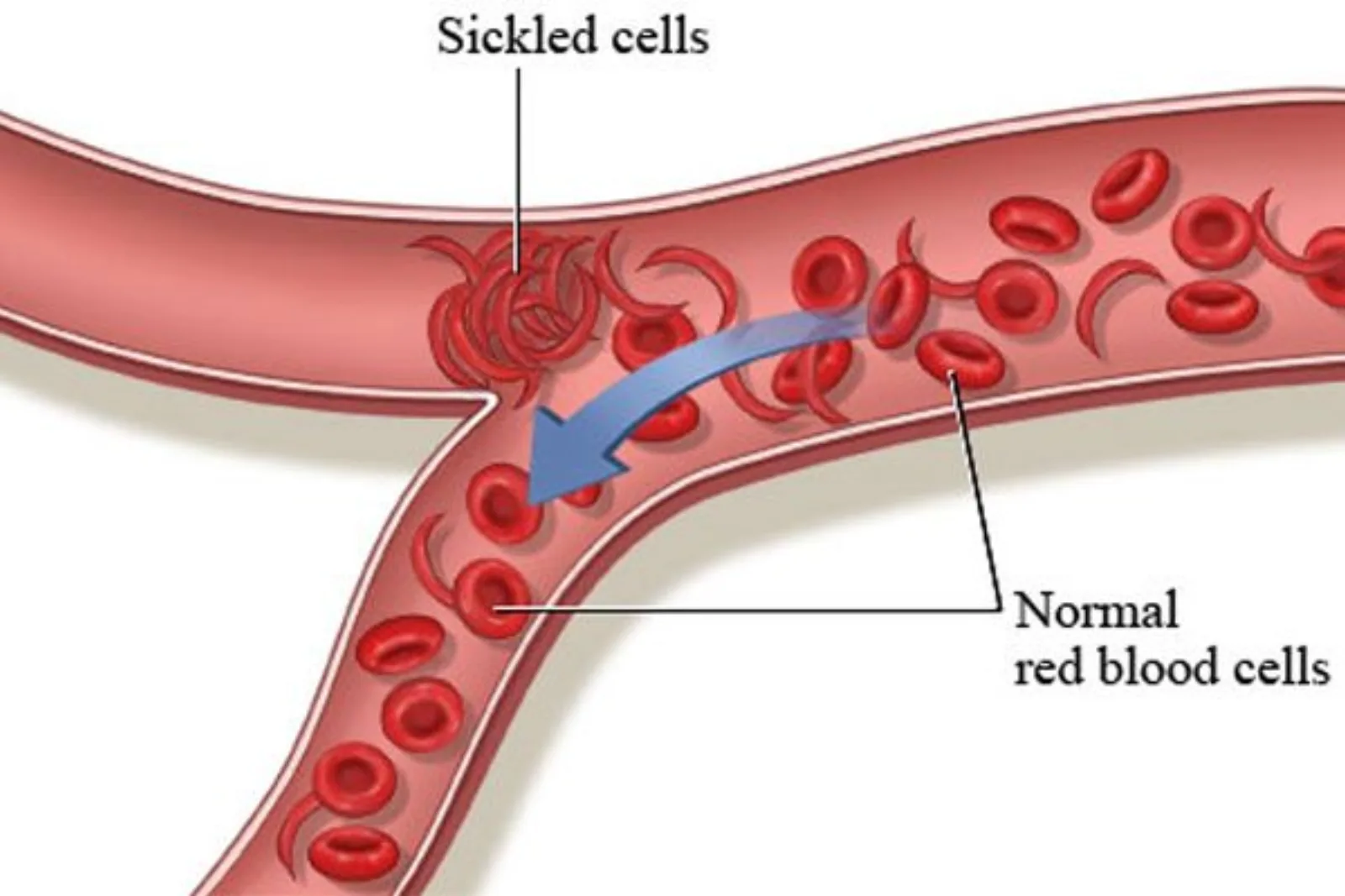 sickle_cells