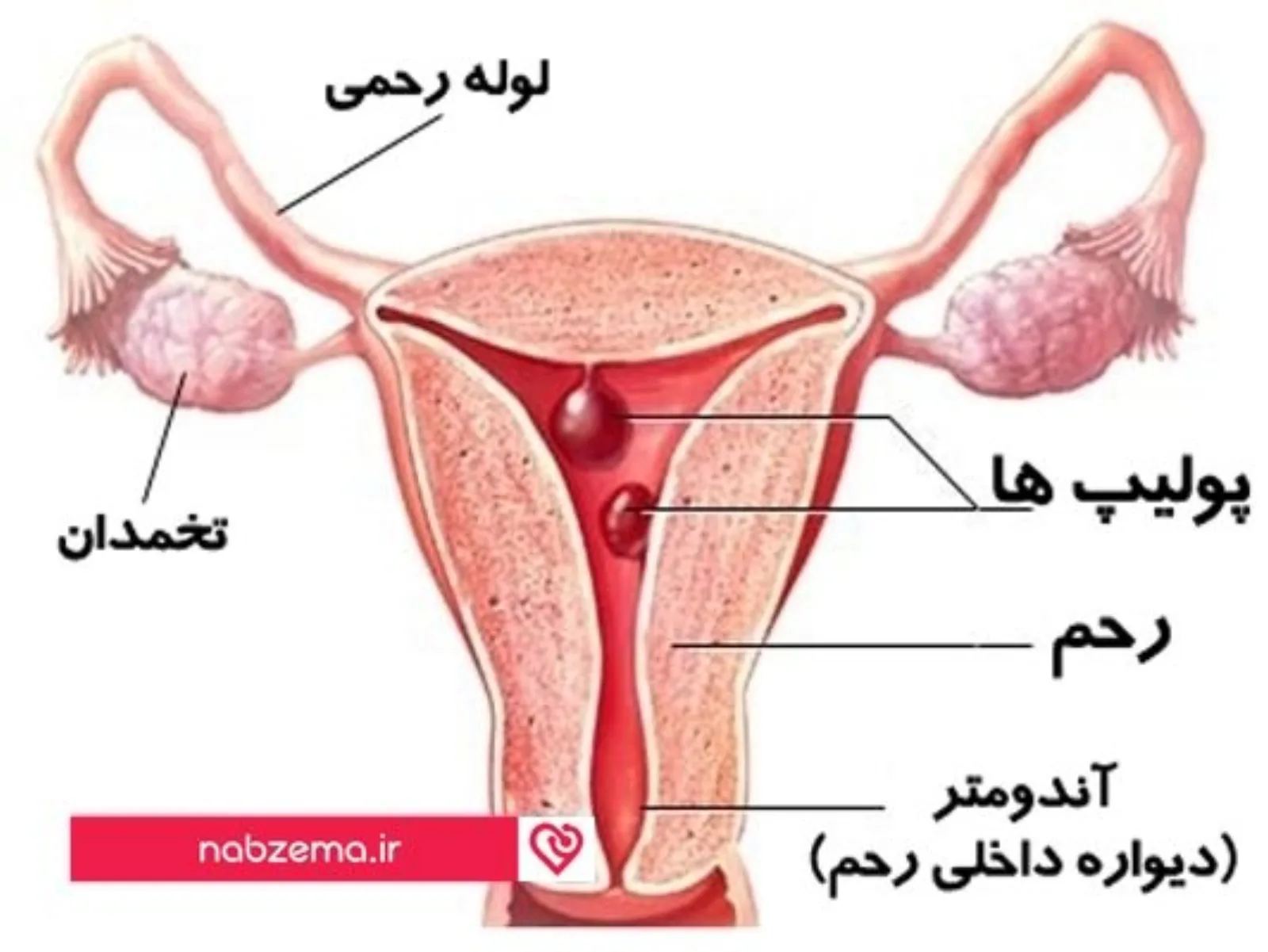 پولیپ رحم
