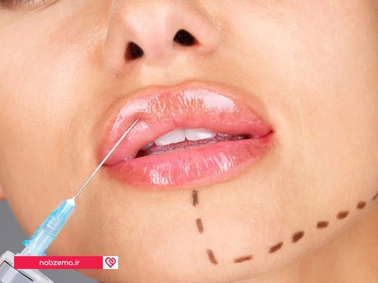 ژل های تزریقی چگونه عمل می کنند؟