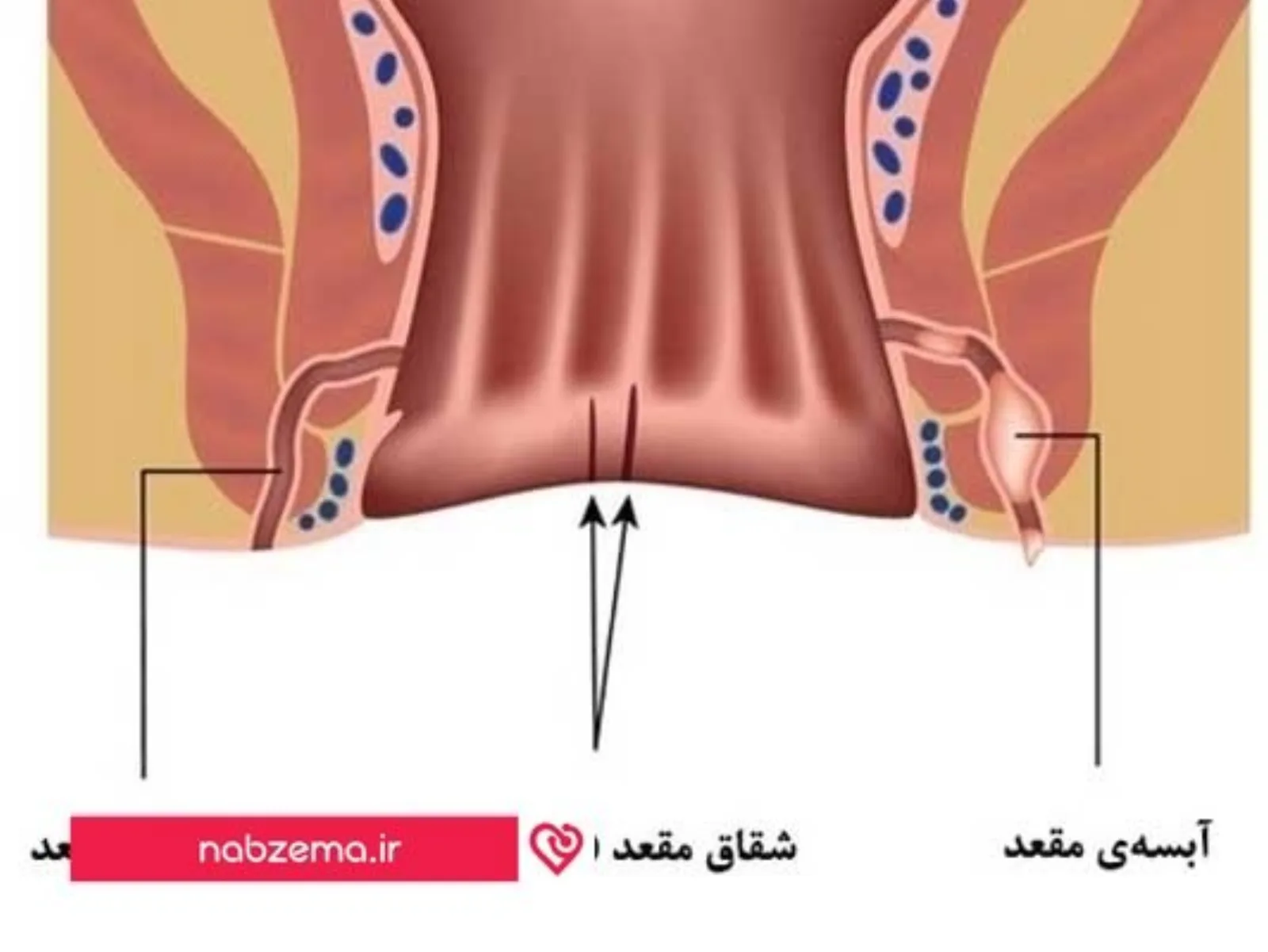 فیستول 
