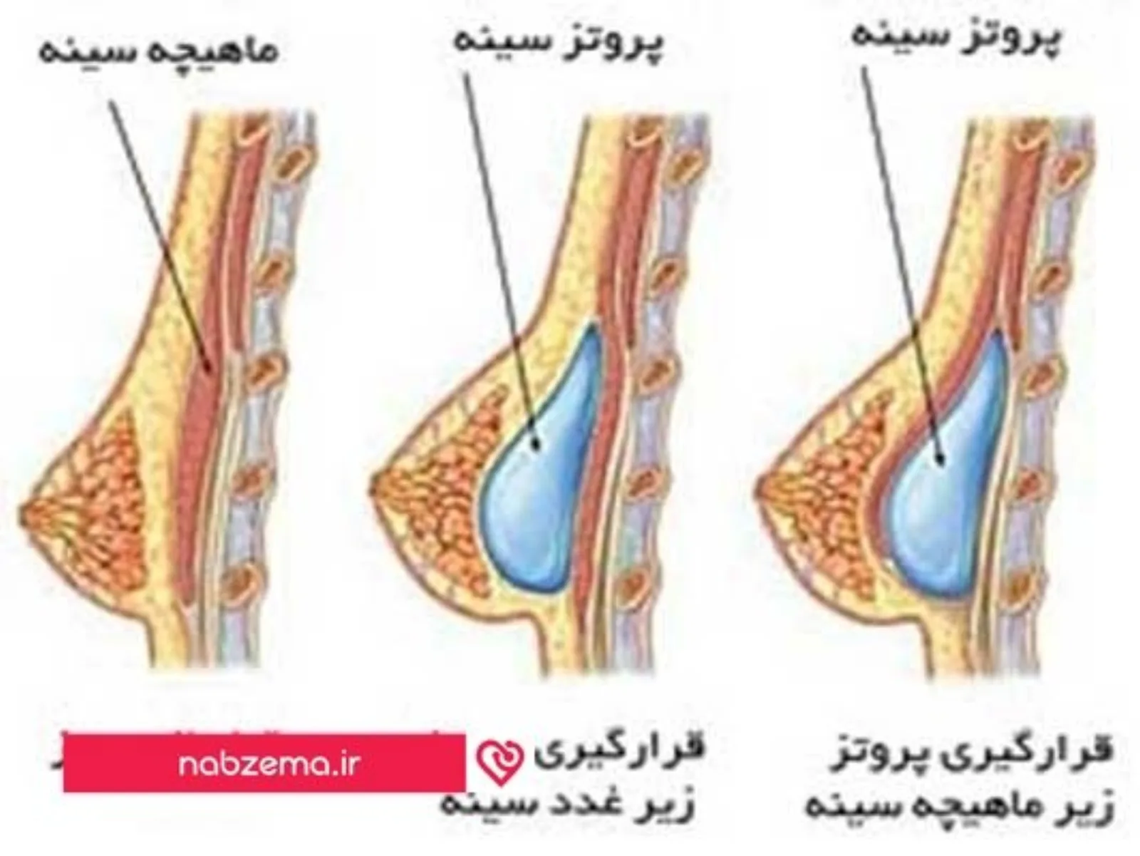 پروتز سینه+عکس