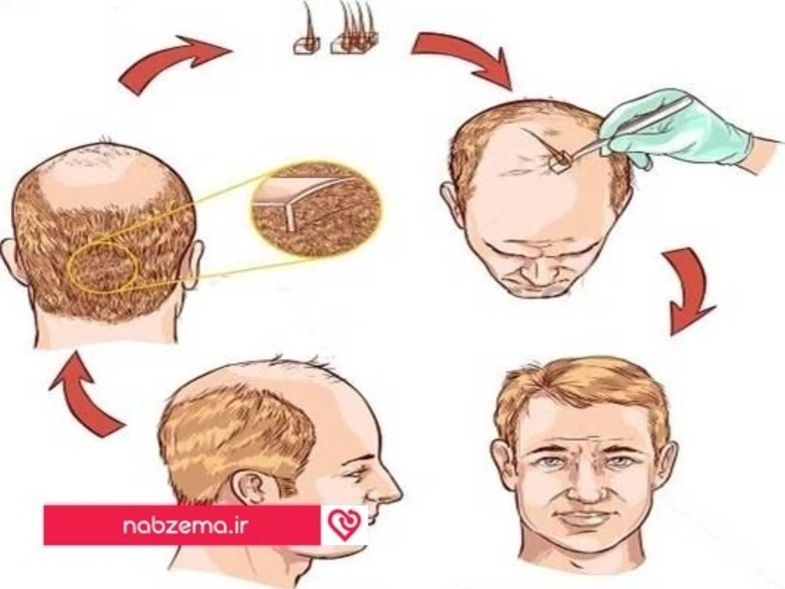 کاشت موها