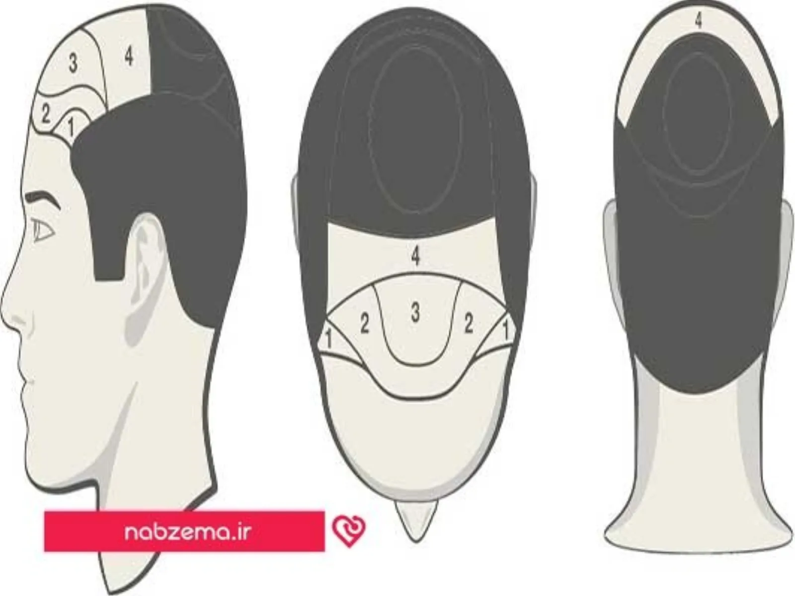 روش کاشت مو
