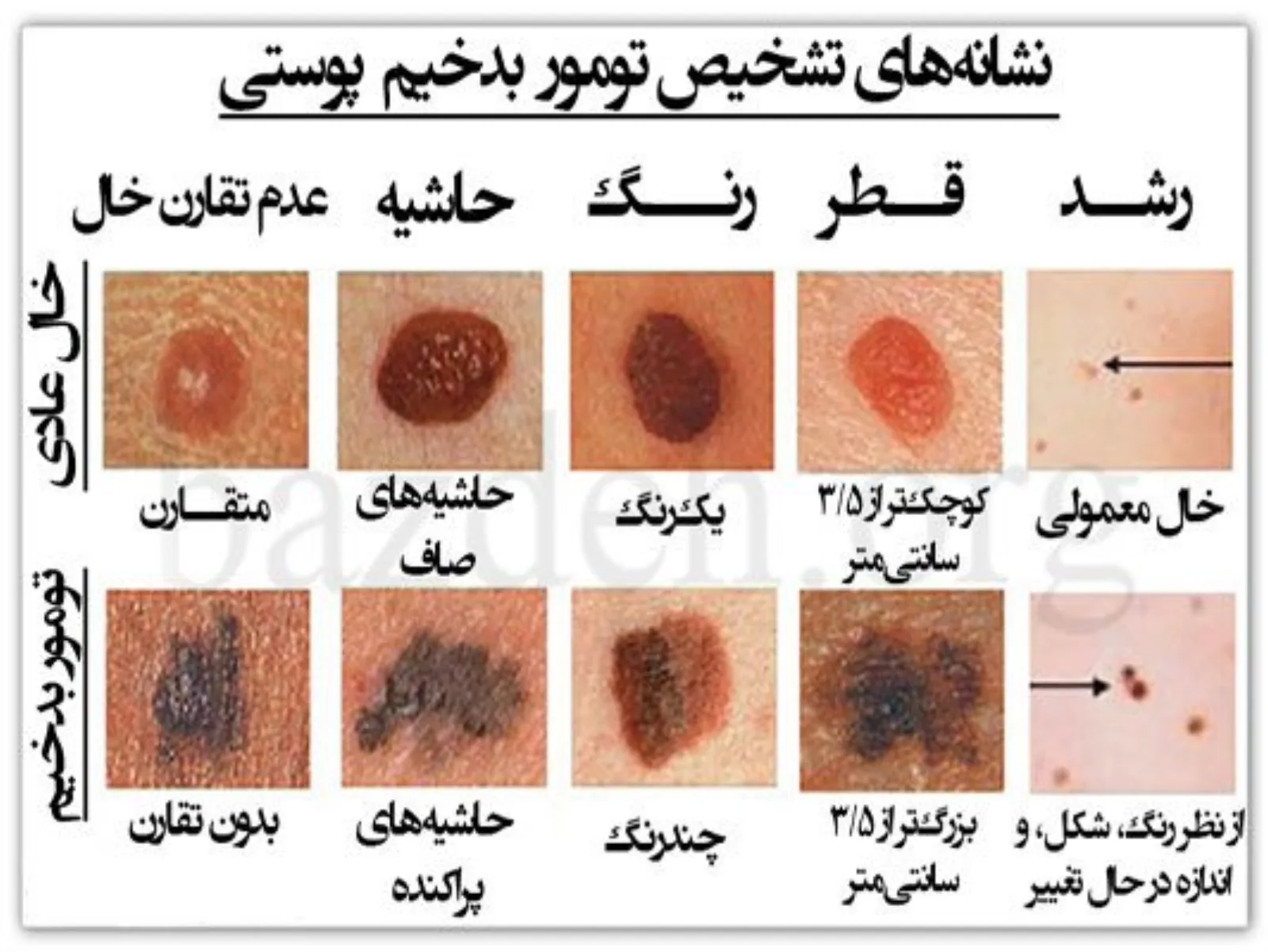 نشانه های خال سرطانی