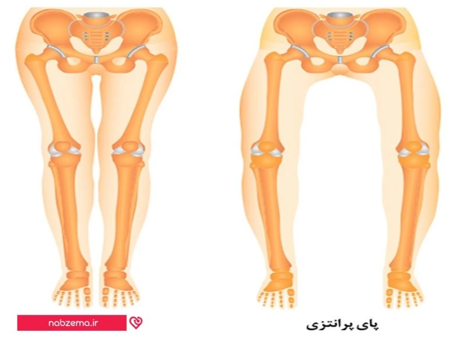 زانوی پرانتزی
