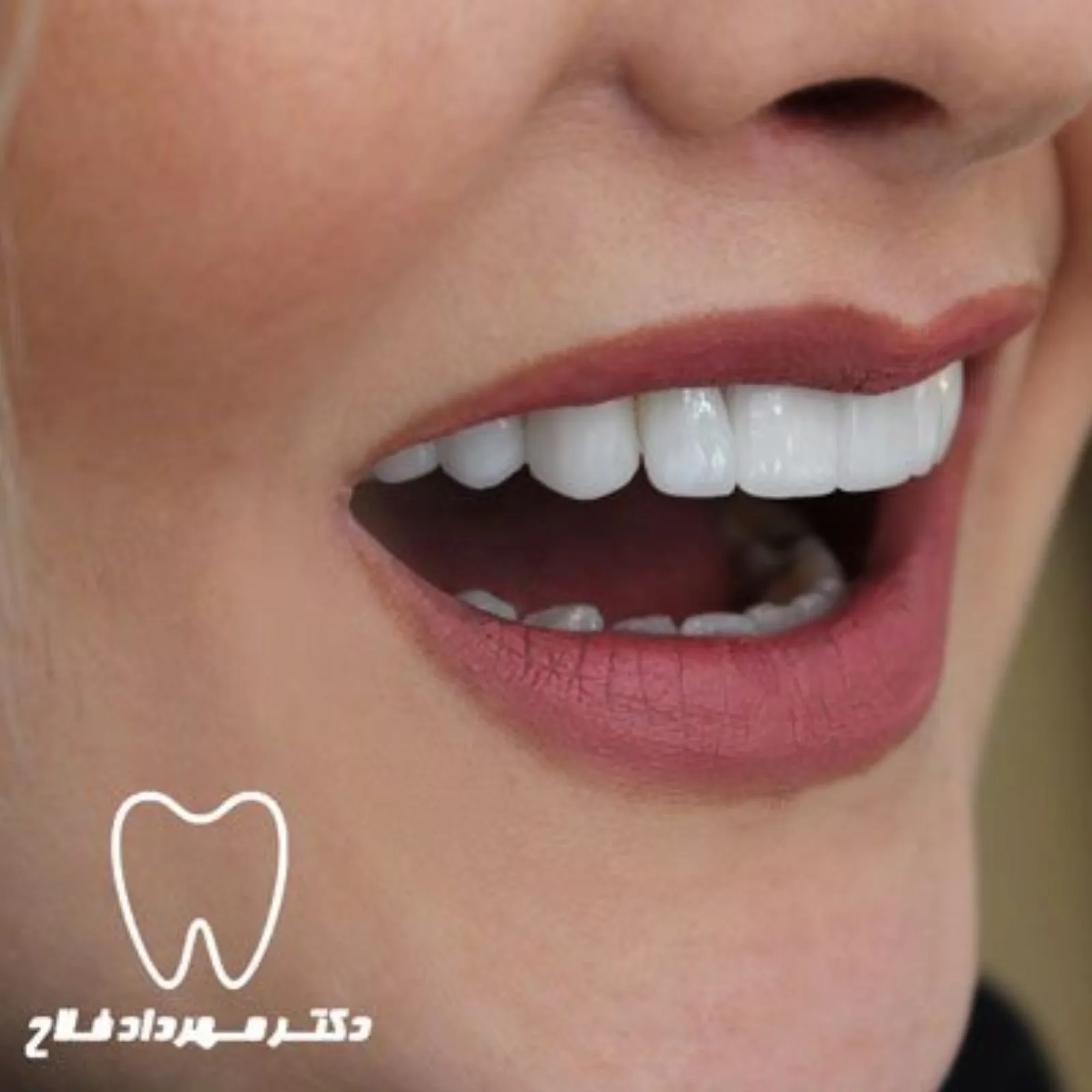 لامینیت دندان دکتر فلاح