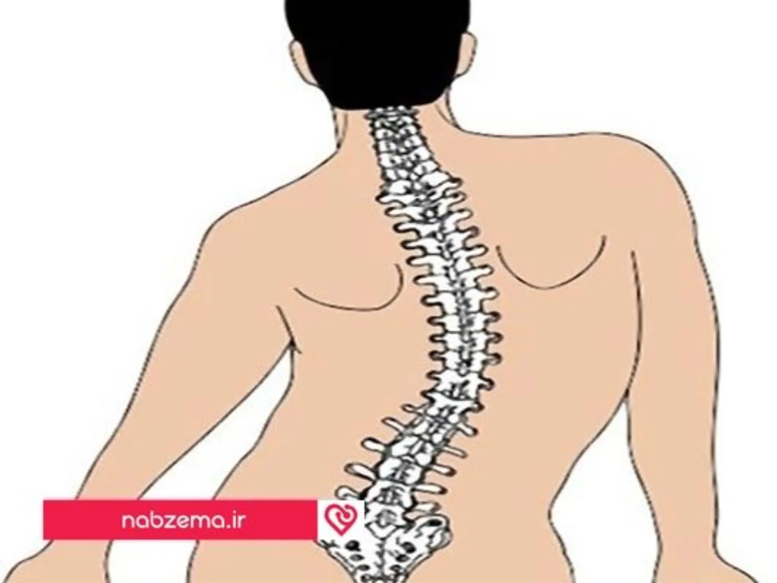 انحراف در ستون فقرات