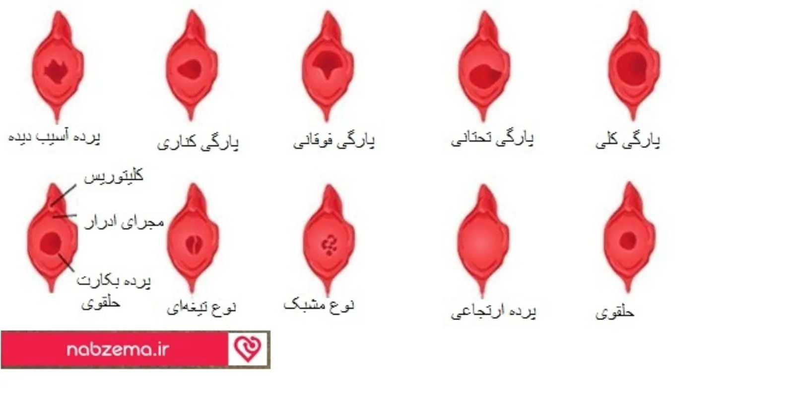پرده بکارت پاره شده