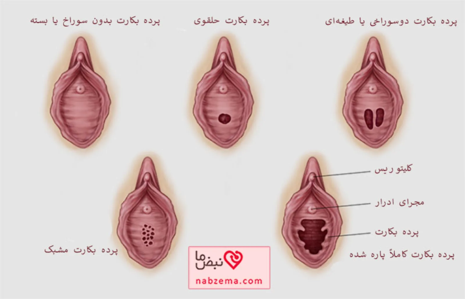 انواع پرده بکارت
