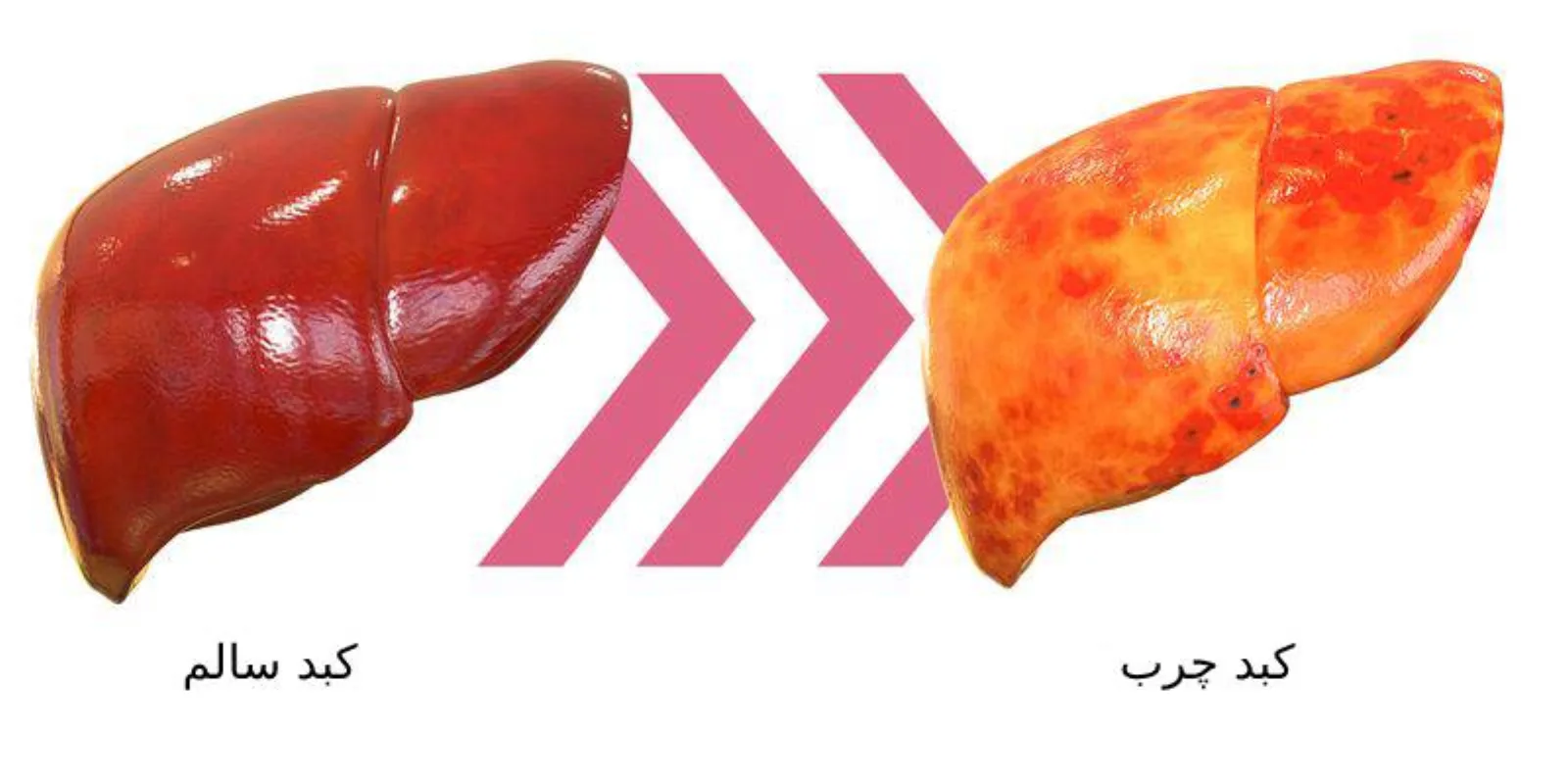 مراحل کبد چرب
