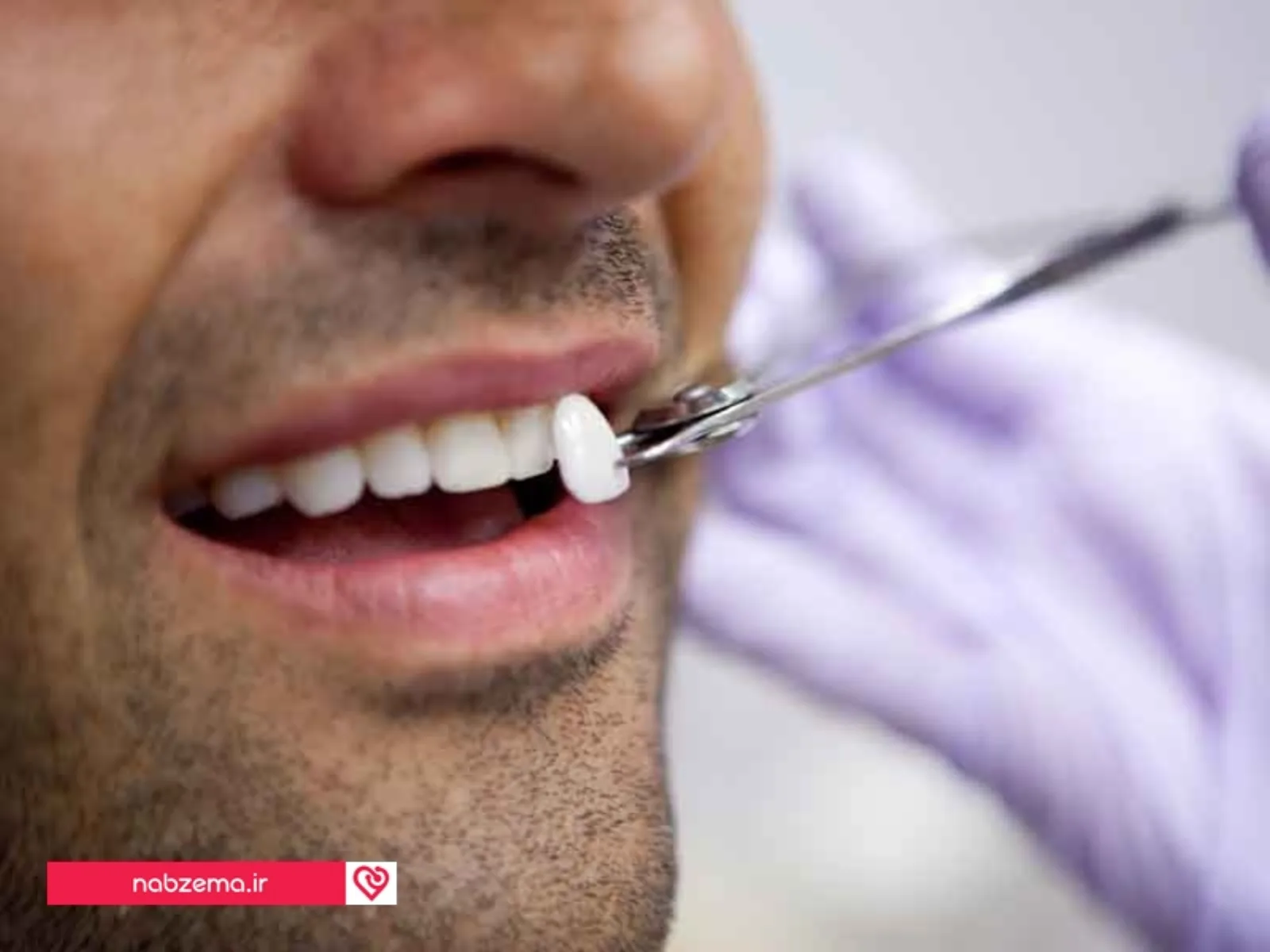تفاوت بلیچینگ دندان و لمینت