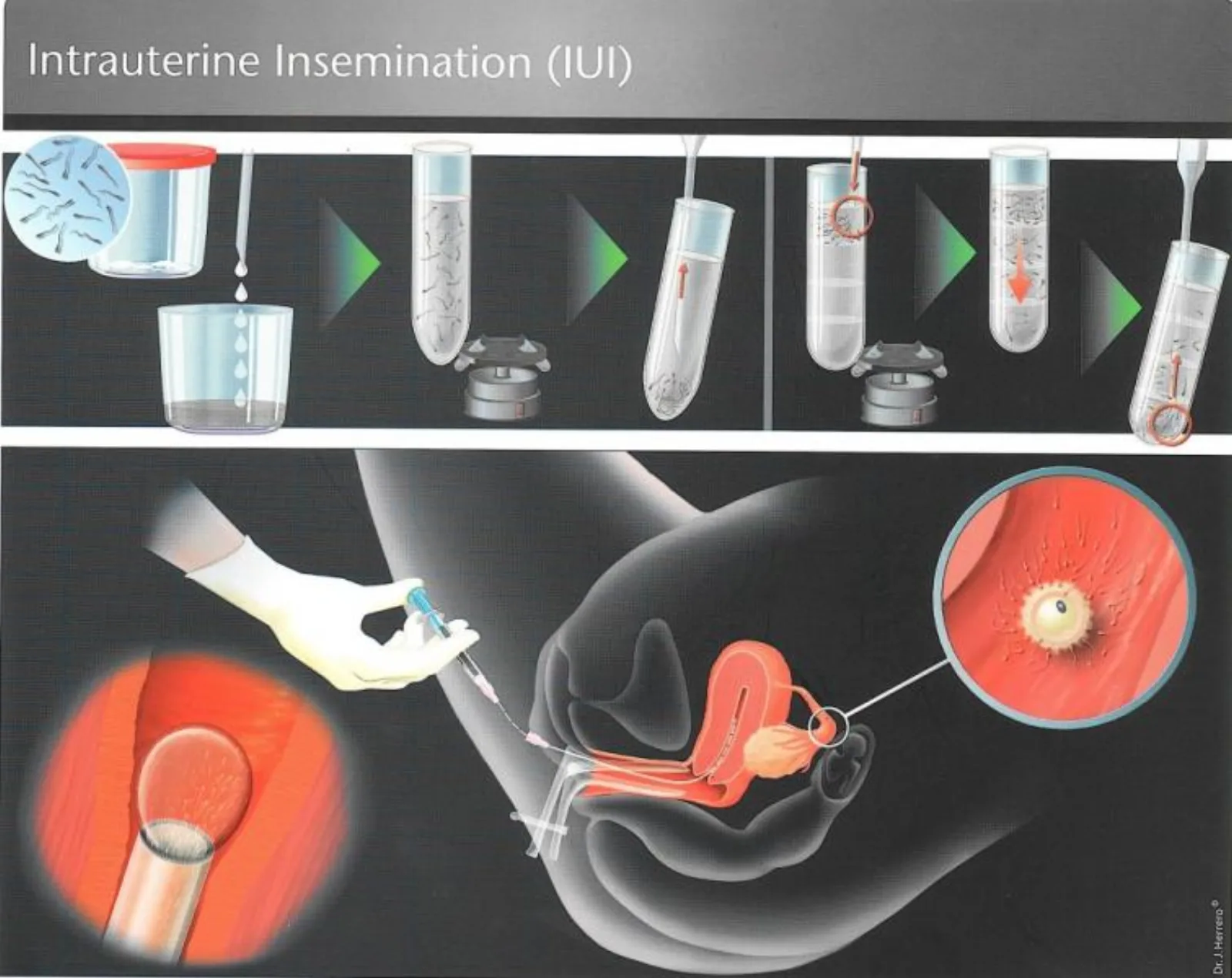 روش iui برای تعیین جنسیت