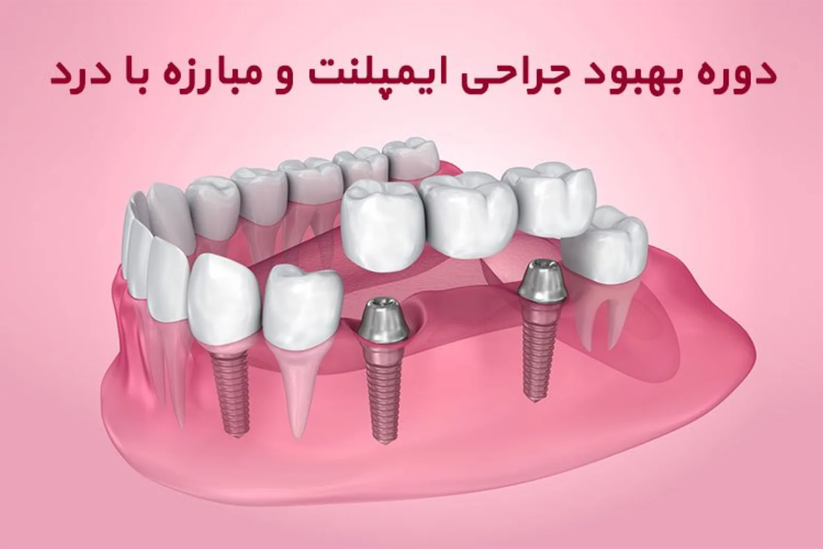 ایمپلنت دندان