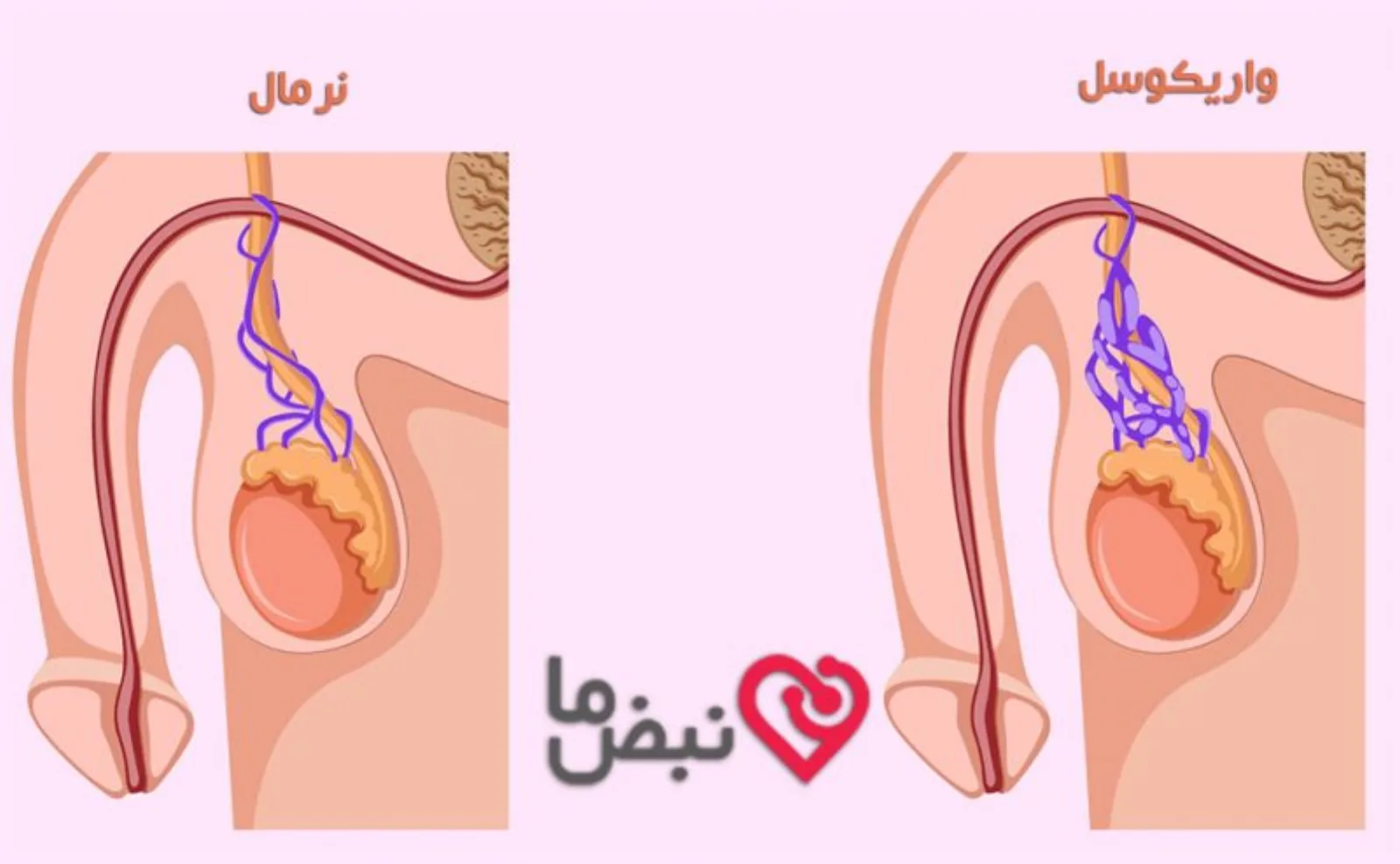 بیضه واریسی و بیضه نرمال