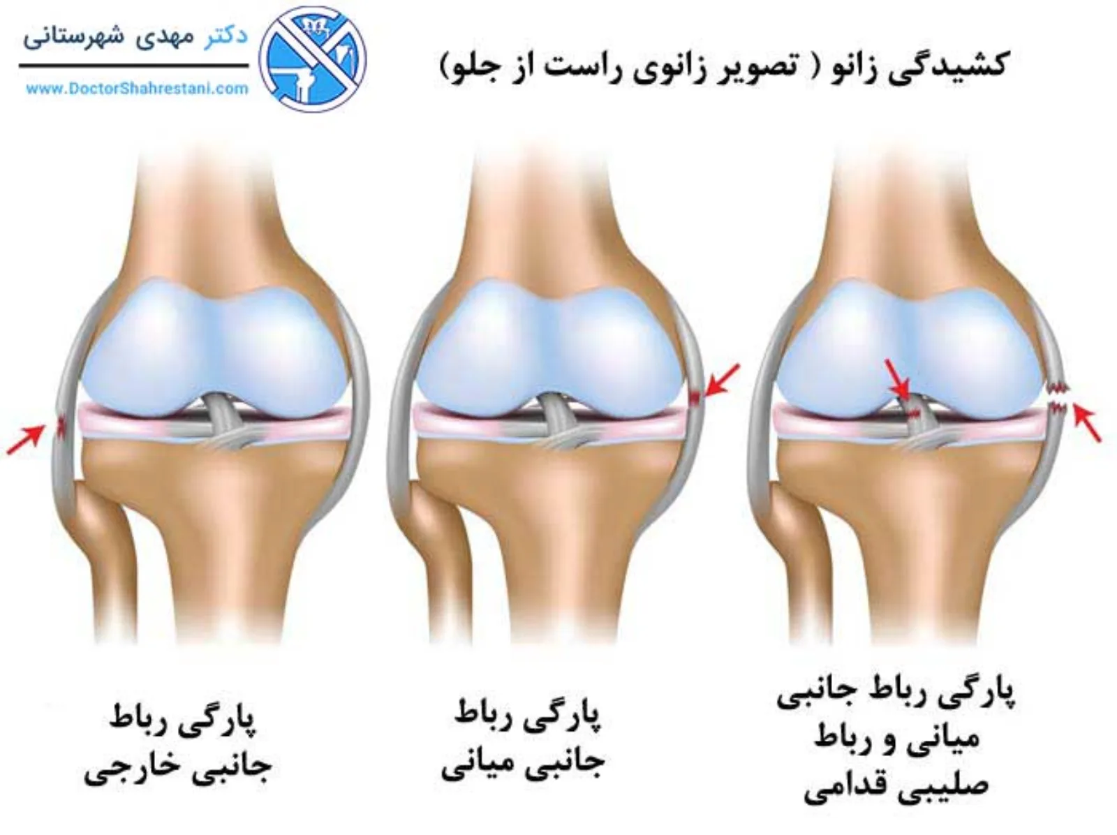 پارگی رباط صلیبی
