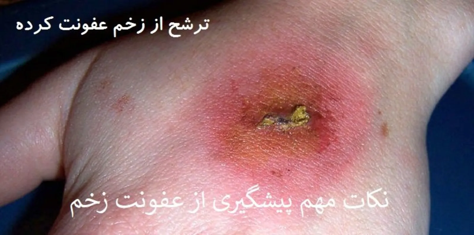 درمان زخم های عفونی دیگر دشوار نیست