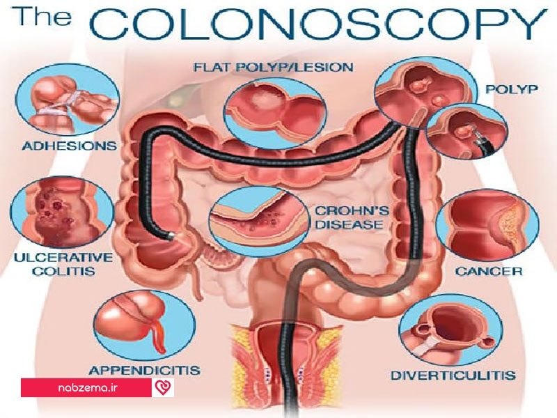 درمان با کولونوسکوپی
