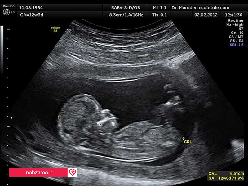 علائم بارداری پسر در سه ماهگی
