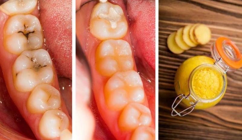 درمان خانگی پوسیدگی دندان