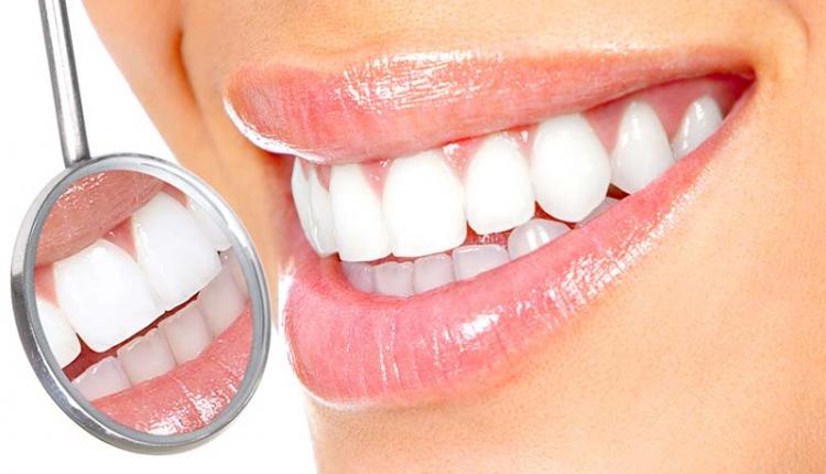 مراحل نصب لمینت دندان