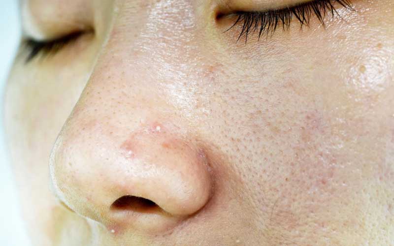 درمان قطعی منافذ باز پوست صورت