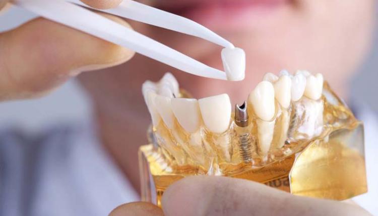 روش کاشت دندان بدون ایمپلنت