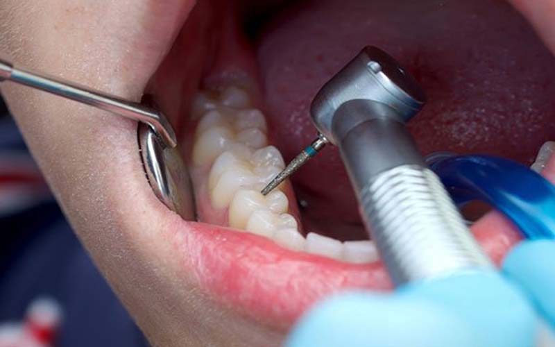 علت درد عصب کشی دندان