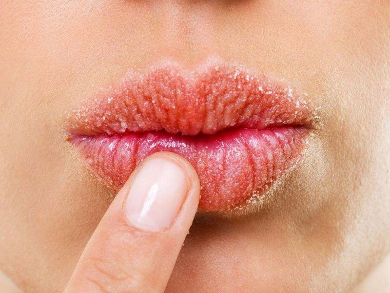 علل، علائم و درمان خشکی لب در منزل + طب سنتی برای درمان خشکی لبها - نبض ما