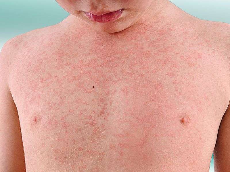 آلرژی نسب به آنتی بیوتیک