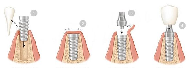  ایمپلنت دندانی