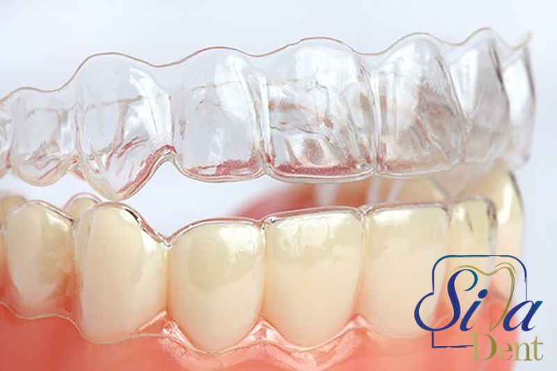 درمان نامرتبی‌های دندانی با ارتودنسی نامرئی چقدر زمان می‌برد؟