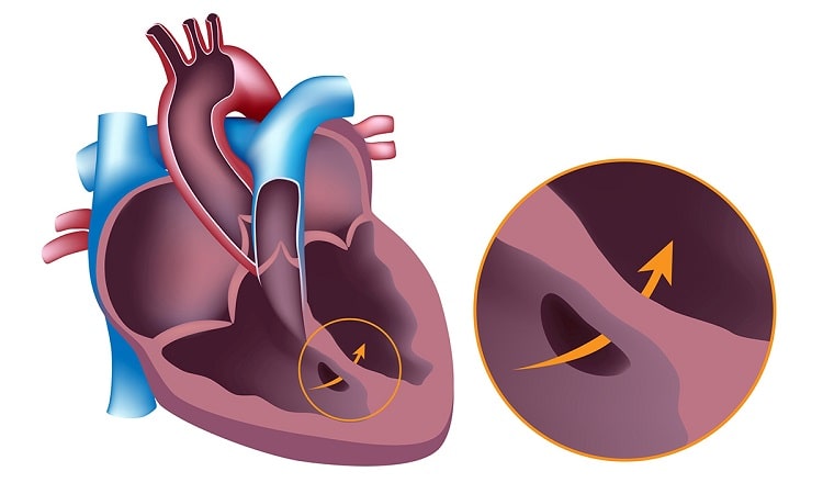 ساختار قلب در سندرم آیزن منگر